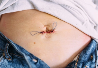 хирург снимает швы на дому